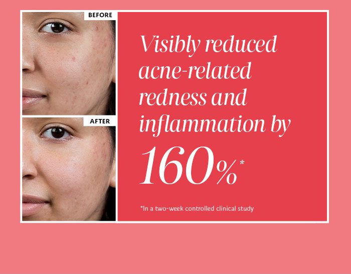Visibily reduced acne-related...