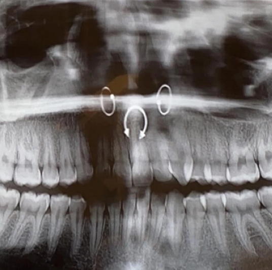 4 More Fascinating Pictures of Body Jewelry in X-Rays