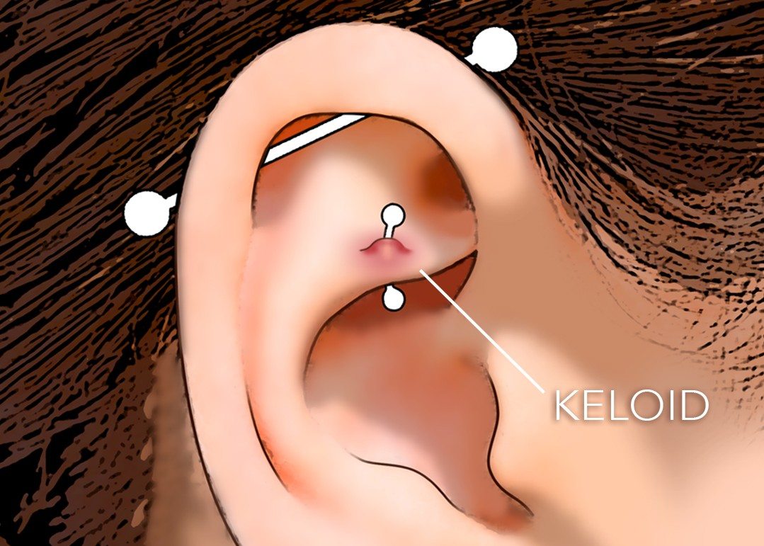 Is It a Keloid or an Irritation Bump?