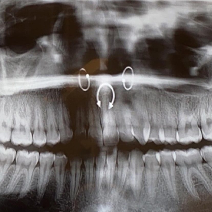 Can You Use Septum Rings for Daith Piercings?